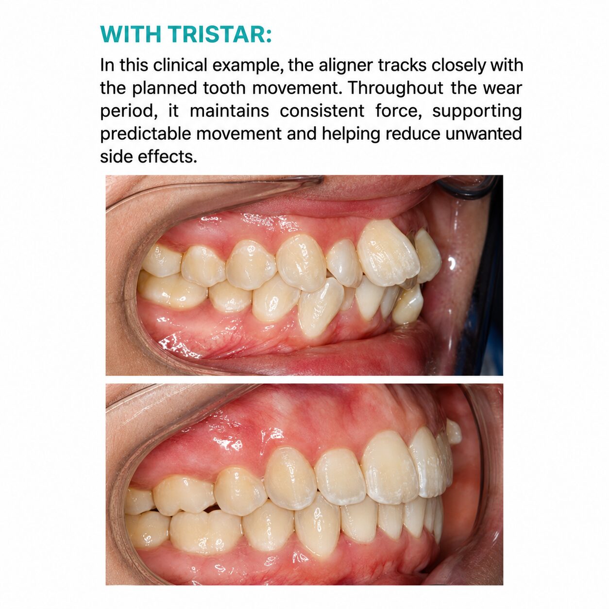Tristar Trubalance 0.76x125 mm - Image 3